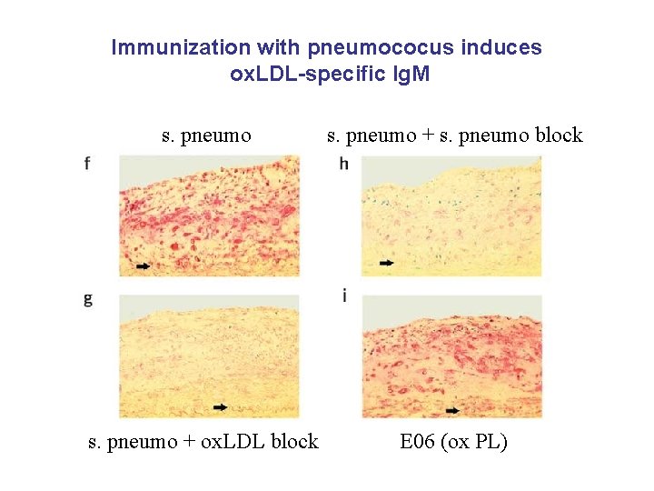 Immunization with pneumococus induces ox. LDL-specific Ig. M s. pneumo + s. pneumo block