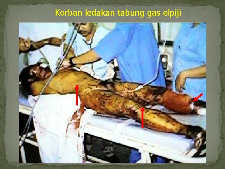 Korban ledakan tabung gas elpiji 