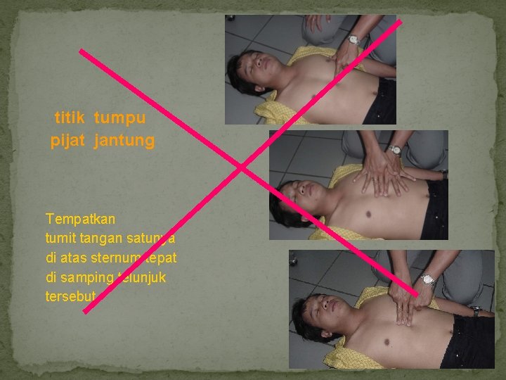  titik tumpu pijat jantung Tempatkan tumit tangan satunya di atas sternum tepat di