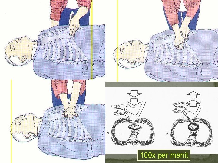 100 x per menit 