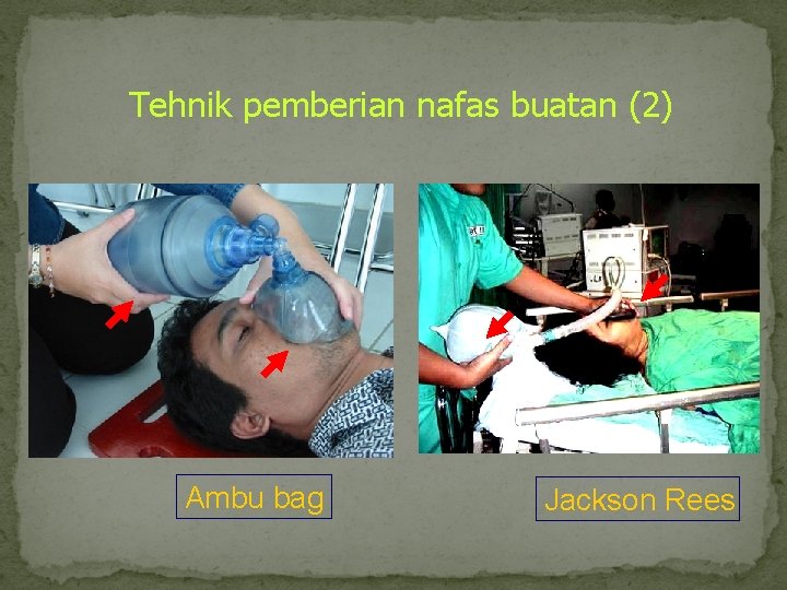 Tehnik pemberian nafas buatan (2) Ambu bag Jackson Rees 