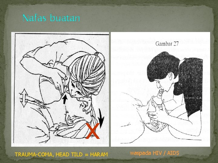 Nafas buatan x TRAUMA COMA, HEAD TILD = HARAM waspada HIV / AIDS 