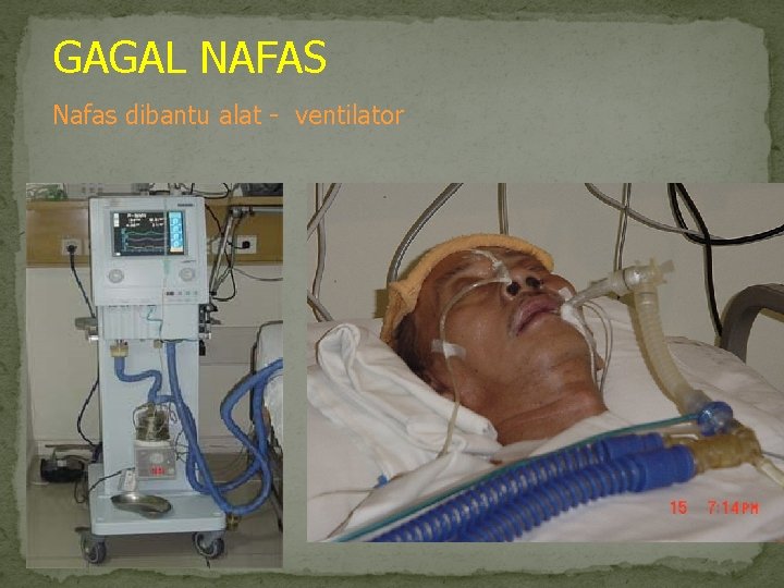 GAGAL NAFAS Nafas dibantu alat ventilator 