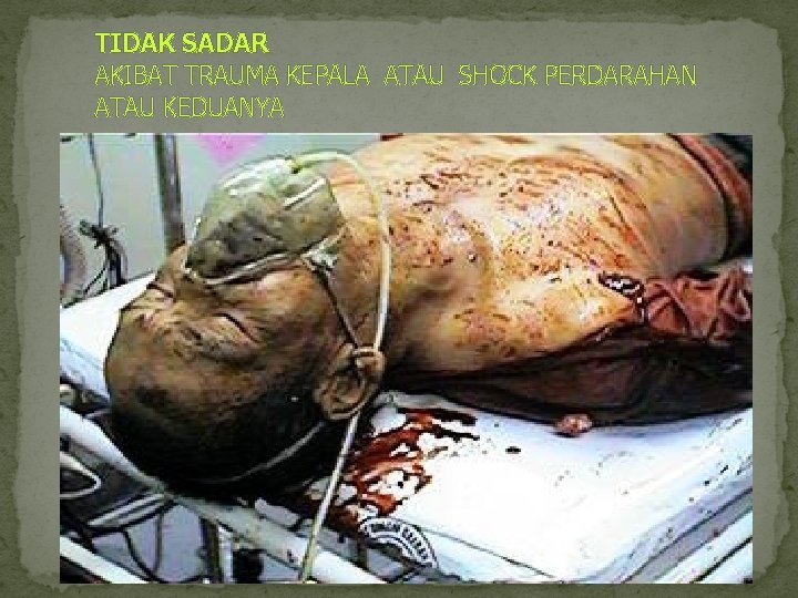 TIDAK SADAR AKIBAT TRAUMA KEPALA ATAU SHOCK PERDARAHAN ATAU KEDUANYA 