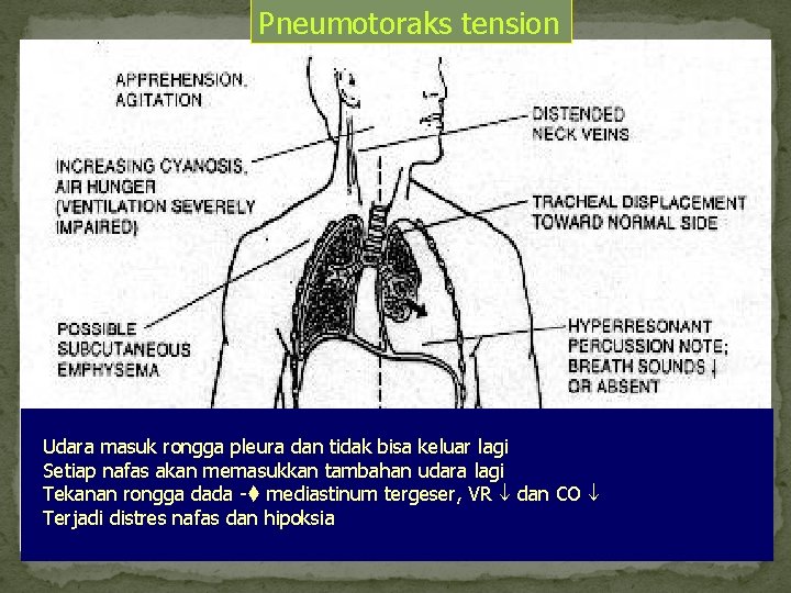 Pneumotoraks tension Udara masuk rongga pleura dan tidak bisa keluar lagi Setiap nafas akan