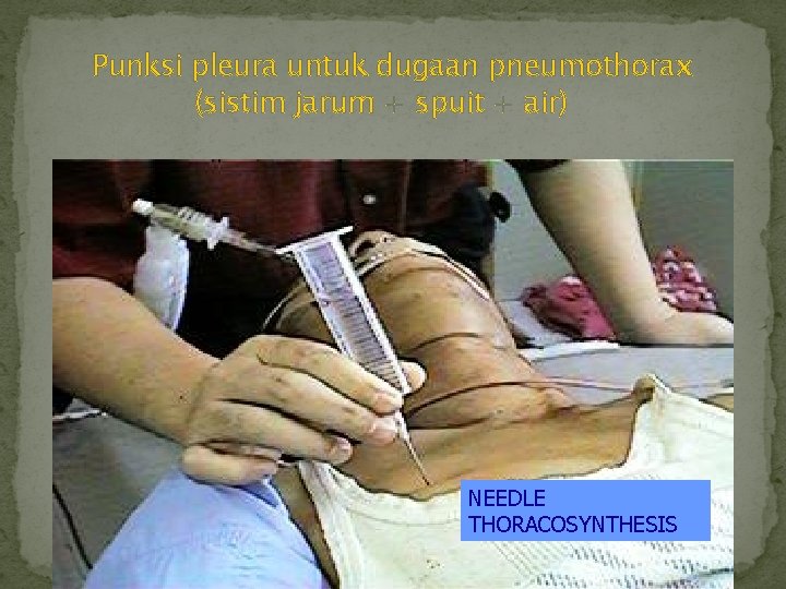 Punksi pleura untuk dugaan pneumothorax (sistim jarum + spuit + air) NEEDLE THORACOSYNTHESIS 
