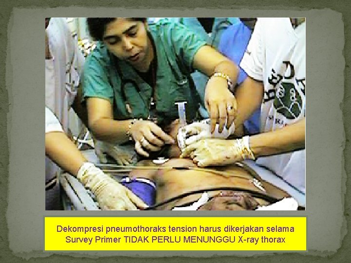 Dekompresi pneumothoraks tension harus dikerjakan selama Survey Primer TIDAK PERLU MENUNGGU X-ray thorax 