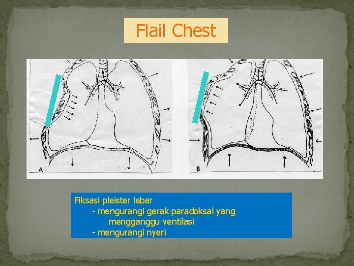 Flail Chest Fiksasi pleister lebar mengurangi gerak paradoksal yang mengganggu ventilasi mengurangi nyeri 