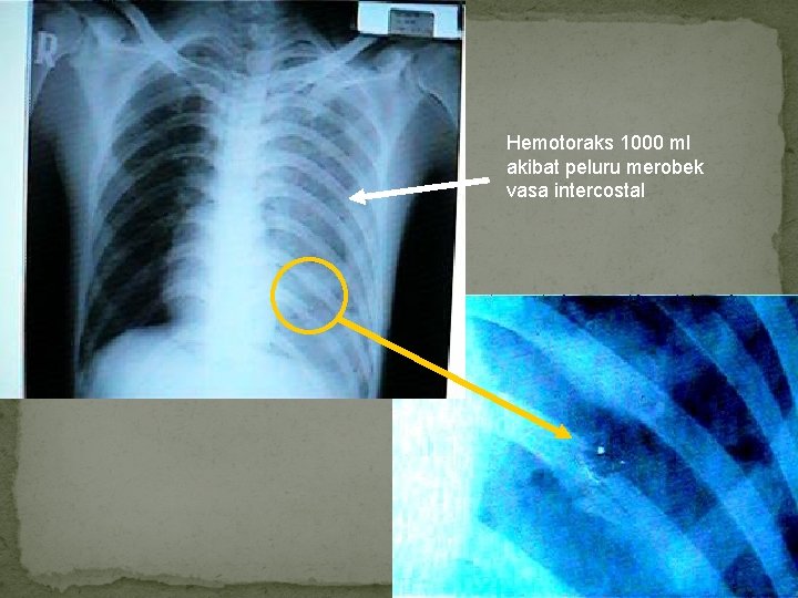 Hemotoraks 1000 ml akibat peluru merobek vasa intercostal 