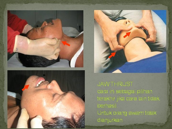 JAW THRUST cara ini sebagai pilihan terakhir jika cara lain tidak berhasil. Untuk orang