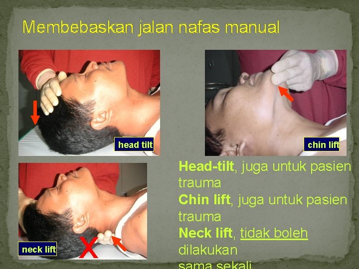 Membebaskan jalan nafas manual head tilt neck lift x chin lift Head-tilt, juga untuk