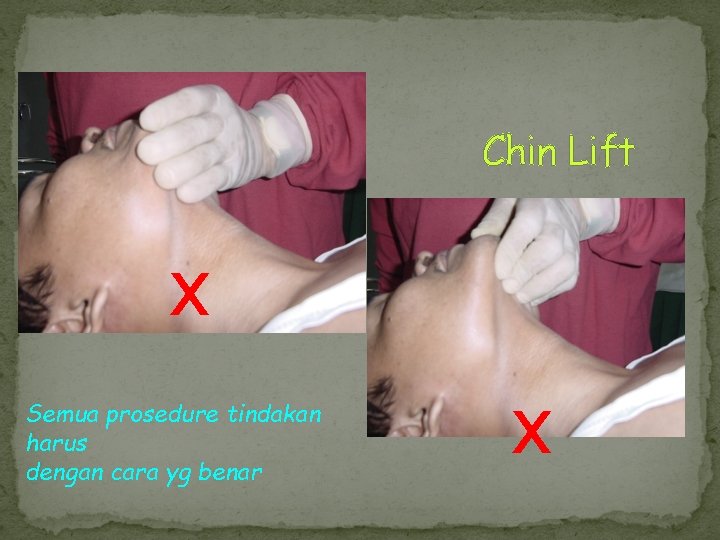 Chin Lift x Semua prosedure tindakan harus dengan cara yg benar x 