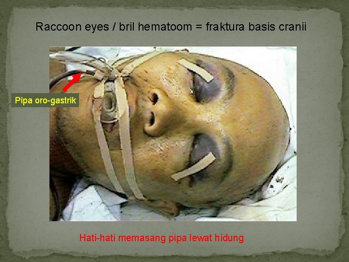 Raccoon eyes / bril hematoom = fraktura basis cranii Pipa oro-gastrik Hati-hati memasang pipa