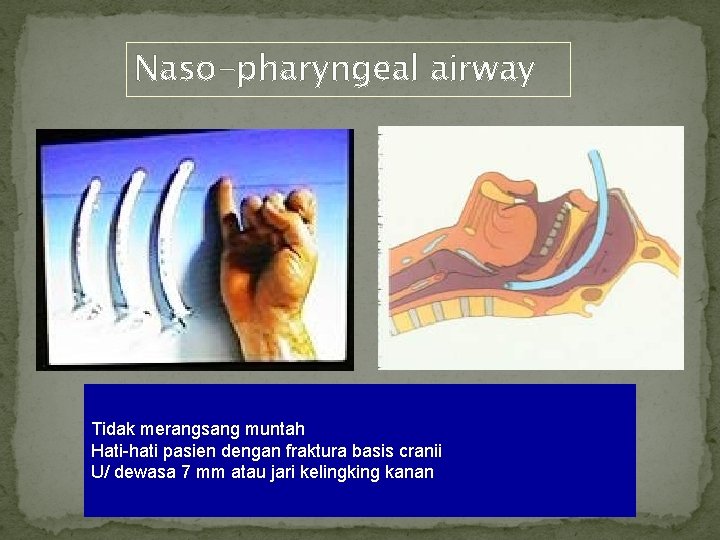 Naso-pharyngeal airway Tidak merangsang muntah Hati-hati pasien dengan fraktura basis cranii U/ dewasa 7