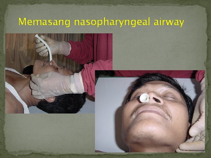 Memasang nasopharyngeal airway 1 a_Airway basic 91 