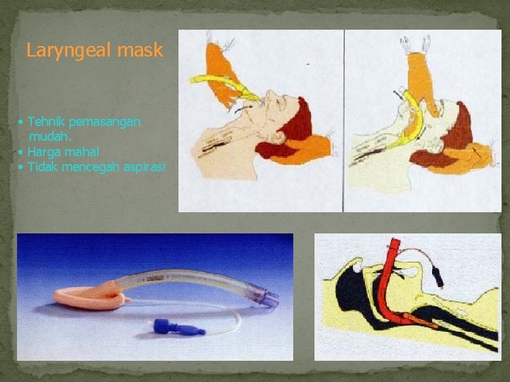 Laryngeal mask • Tehnik pemasangan mudah. • Harga mahal • Tidak mencegah aspirasi 