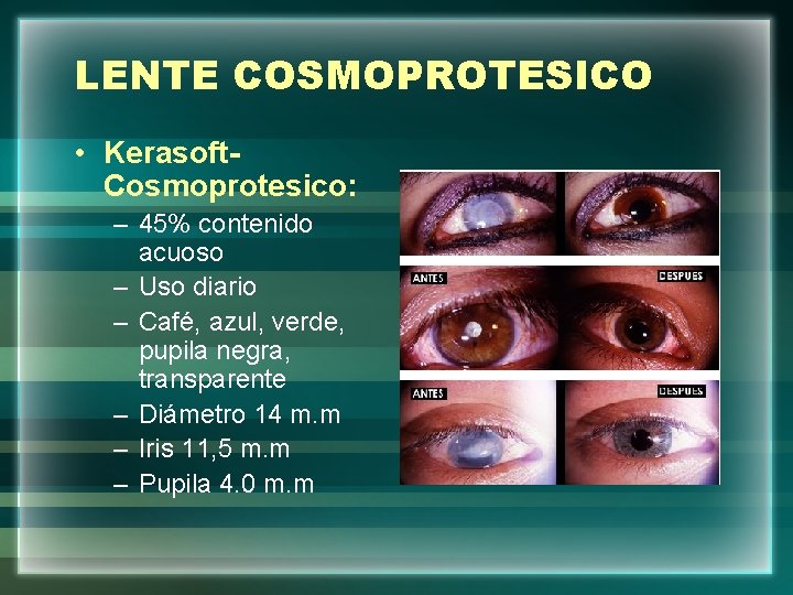 LENTE COSMOPROTESICO • Kerasoft. Cosmoprotesico: – 45% contenido acuoso – Uso diario – Café,