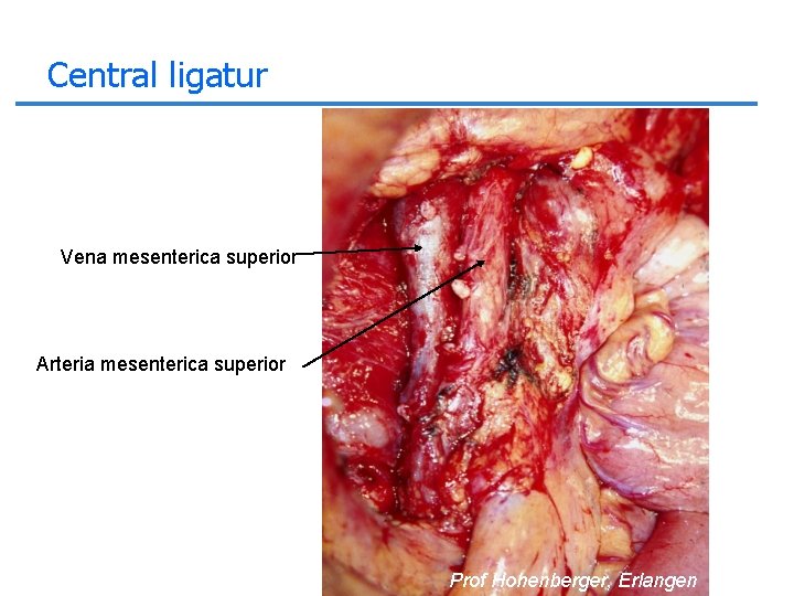 Central ligatur Vena mesenterica superior Arteria mesenterica superior Prof Hohenberger, Erlangen 