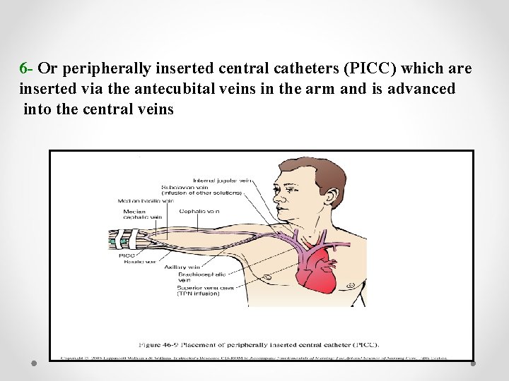 6 - Or peripherally inserted central catheters (PICC) which are inserted via the antecubital