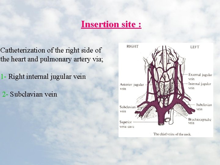 Insertion site : Catheterization of the right side of the heart and pulmonary artery