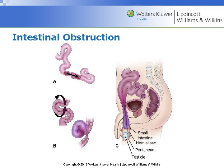 Intestinal Obstruction Copyright © 2013 Wolters Kluwer Health | Lippincott Williams & Wilkins 