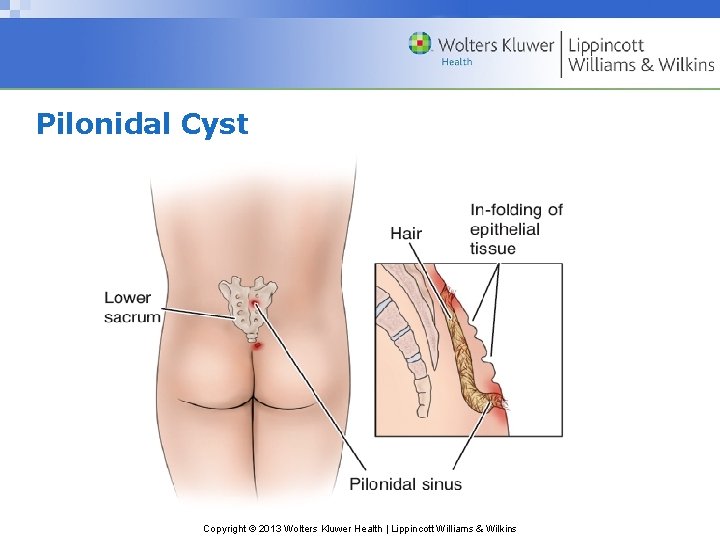 Pilonidal Cyst Copyright © 2013 Wolters Kluwer Health | Lippincott Williams & Wilkins 