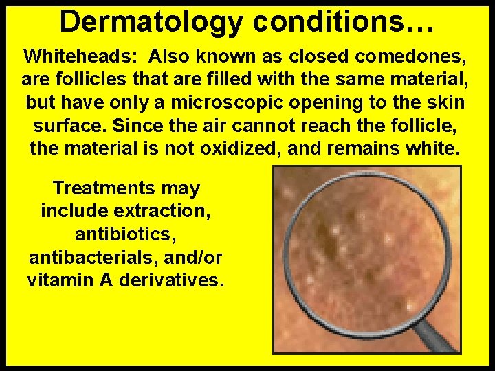 Dermatology conditions… Whiteheads: Also known as closed comedones, are follicles that are filled with