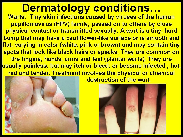 Dermatology conditions… Warts: Tiny skin infections caused by viruses of the human papillomavirus (HPV)