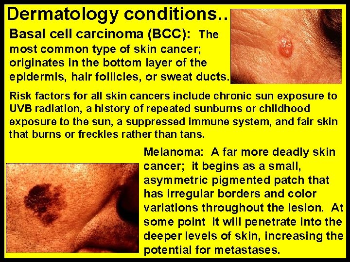 Dermatology conditions… Basal cell carcinoma (BCC): The most common type of skin cancer; originates