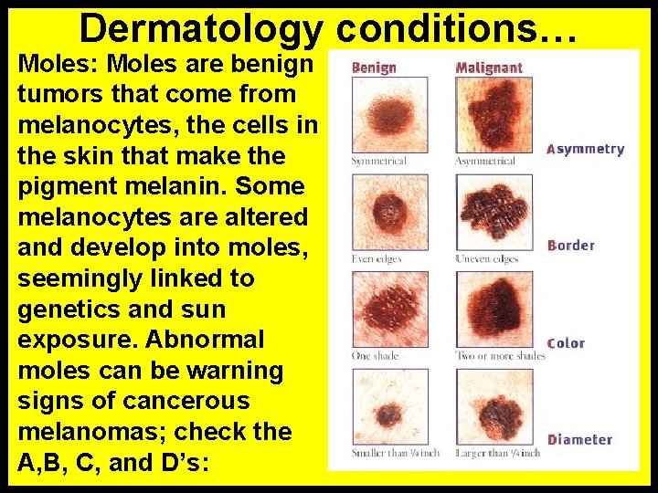 Dermatology conditions… Moles: Moles are benign tumors that come from melanocytes, the cells in
