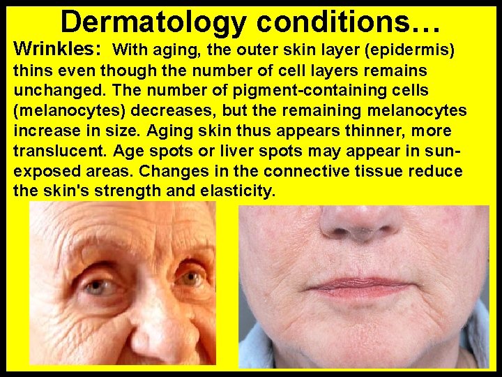 Dermatology conditions… Wrinkles: With aging, the outer skin layer (epidermis) thins even though the
