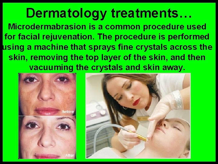 Dermatology treatments… Microdermabrasion is a common procedure used for facial rejuvenation. The procedure is