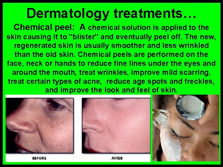 Dermatology treatments… Chemical peel: A chemical solution is applied to the skin causing it