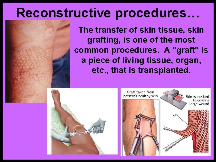 Reconstructive procedures… The transfer of skin tissue, skin grafting, is one of the most