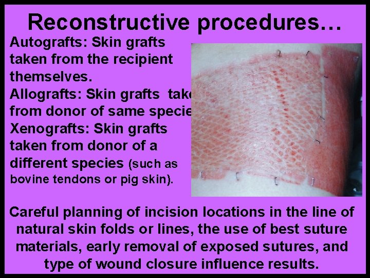 Reconstructive procedures… Autografts: Skin grafts taken from the recipient themselves. Allografts: Skin grafts taken