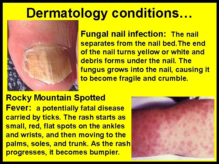 Dermatology conditions… Fungal nail infection: The nail separates from the nail bed. The end