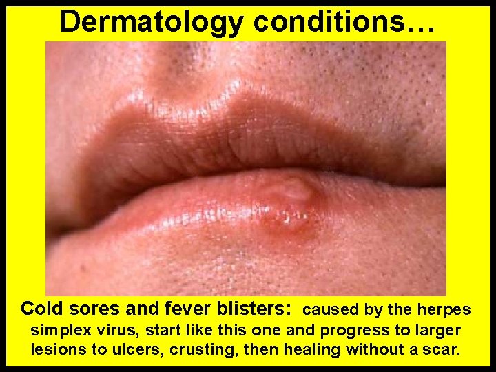 Dermatology conditions… Cold sores and fever blisters: caused by the herpes simplex virus, start