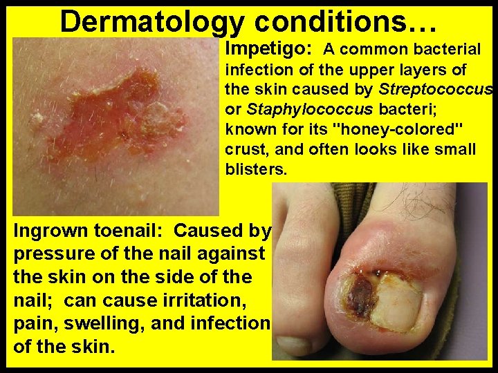 Dermatology conditions… Impetigo: A common bacterial infection of the upper layers of the skin