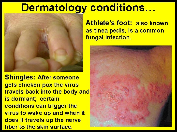 Dermatology conditions… Athlete’s foot: also known as tinea pedis, is a common fungal infection.