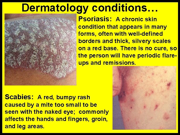 Dermatology conditions… Psoriasis: A chronic skin condition that appears in many forms, often with