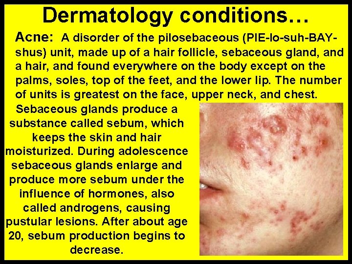 Dermatology conditions… Acne: A disorder of the pilosebaceous (PIE-lo-suh-BAYshus) unit, made up of a