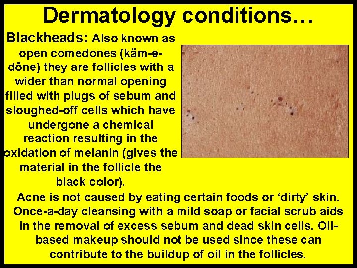 Dermatology conditions… Blackheads: Also known as open comedones (käm-ədōne) they are follicles with a