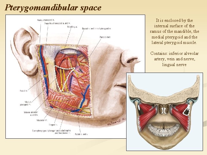 Pterygomandibular space It is enclosed by the internal surface of the ramus of the