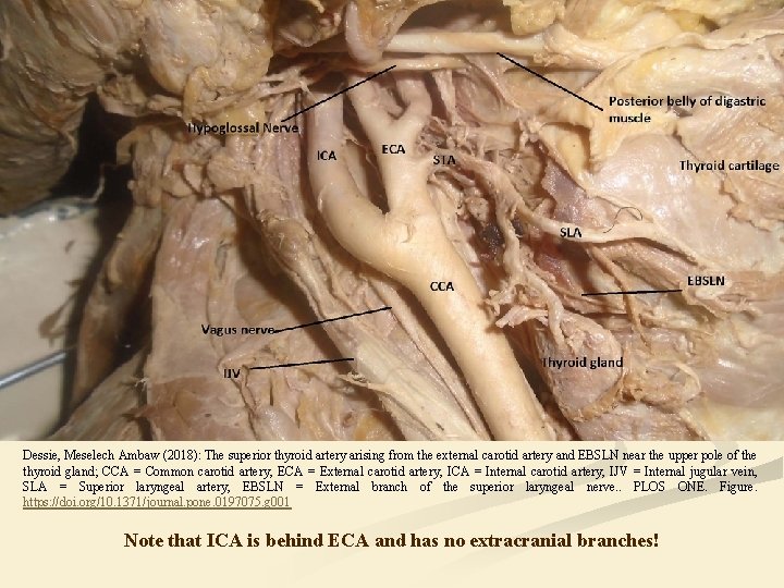 Dessie, Meselech Ambaw (2018): The superior thyroid artery arising from the external carotid artery