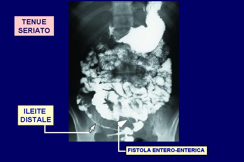 TENUE SERIATO ILEITE DISTALE FISTOLA ENTERO-ENTERICA 