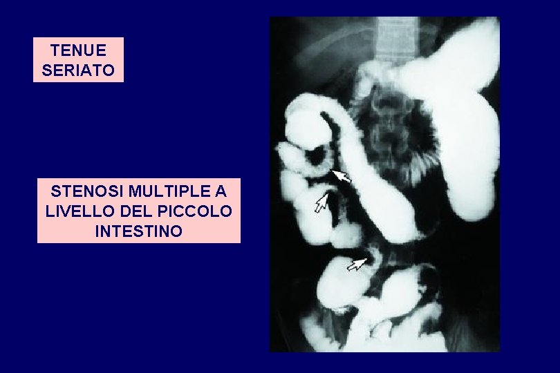 TENUE SERIATO STENOSI MULTIPLE A LIVELLO DEL PICCOLO INTESTINO 