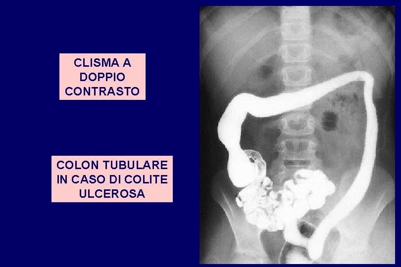 CLISMA A DOPPIO CONTRASTO COLON TUBULARE IN CASO DI COLITE ULCEROSA 