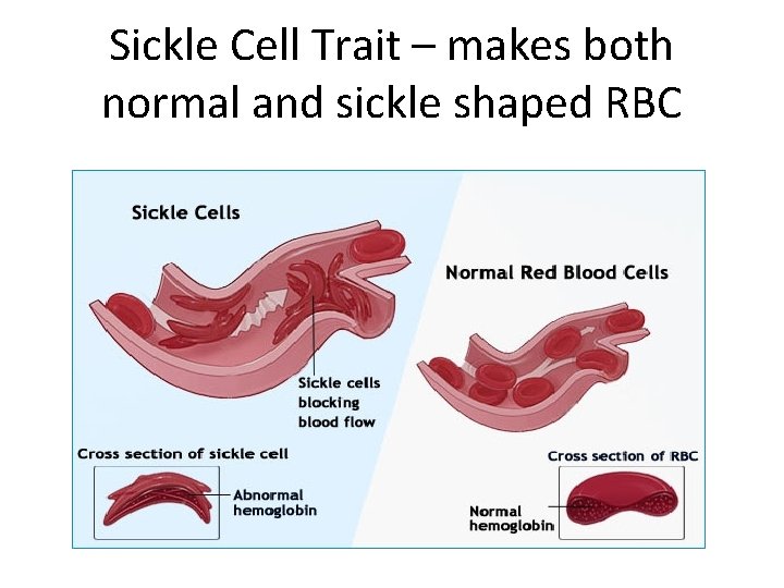 Sickle Cell Trait – makes both normal and sickle shaped RBC 