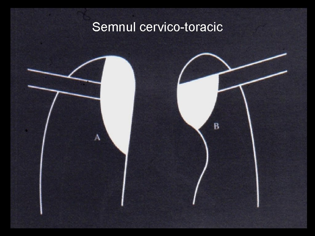 Semnul cervico-toracic 