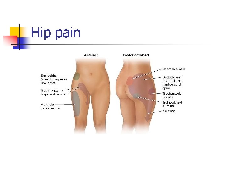 Hip pain 